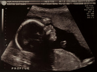Ultrasound